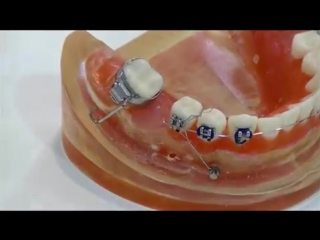 video dr mazor yoav molar masialization power arm mini screw ортодонтия израильский ролик sex