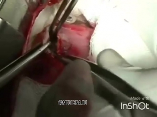 video извлечение паразитов операция на открытом сердце sex