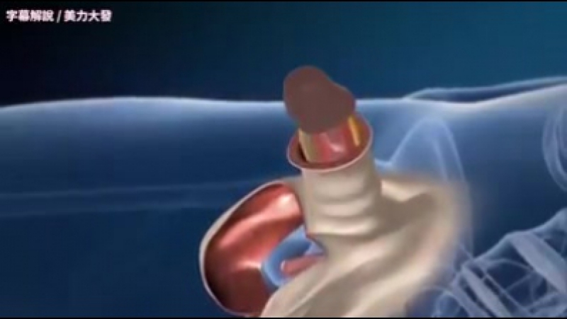 video как меняют пол с мужского на женский sex