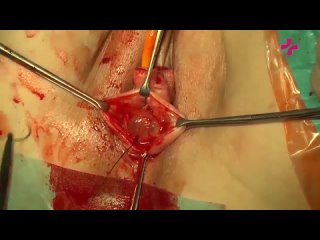 video хирургическое лечение выпадения влагалища после удаления матки sex