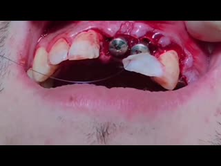 video немедленная имплантация немедленная нагрузка sex