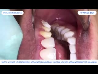 video ochistkazubov ru комплексная профессиональная чистка зубов в казани sex