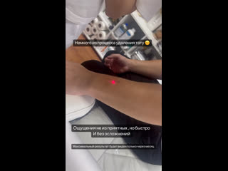 video видео от mindal laser эпиляция удаление тату карбоновый п sex