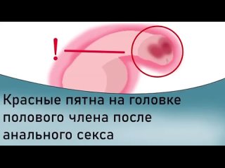 video красные пятна на половом члене после анального секса sex