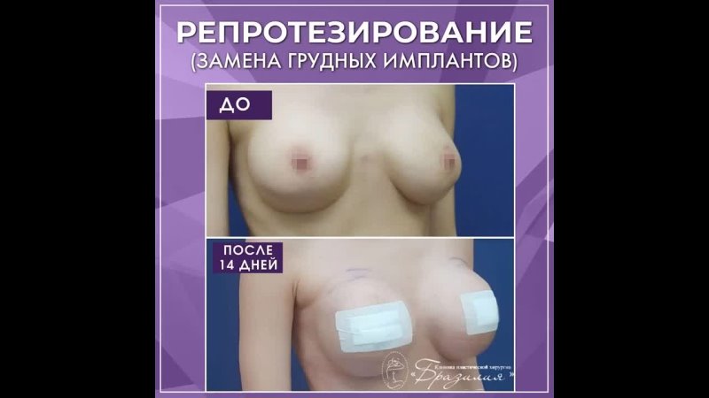 video замена грудных имплантов оперировал суров и а mp4 sex