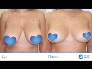 video до и после редукционная маммопластика выполнена в клинике doctorplastic sex