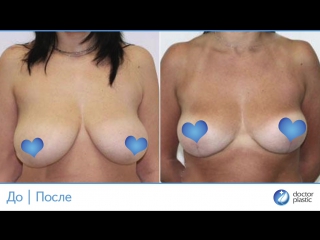 video до и после редукционная маммопластика выполнена в клинике doctorplastic sex