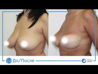 video до и после редукционная маммопластика в клинике doctor plastic sex