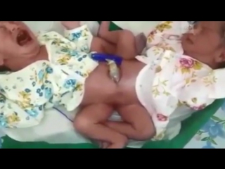 video сиамские близнецы родились в индии sex