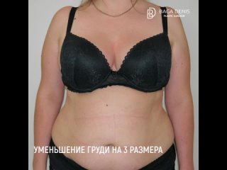 video маммопластика уменьшение груди sex