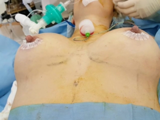 video увеличение груди после операции хирург шаповалов сергей георгиевич sex