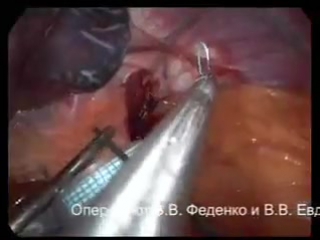 video устаноа бандажа bioring с испотльзованием инстумента goldfinger без комментариев sex