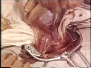 video овариоэктомия удаление яичников при раке молочной железы oophorectomy removal of the ovaries sex