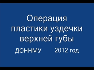 video операция пластики уздечки верхней губы френулопластика при диастеме молодые стоматология sex