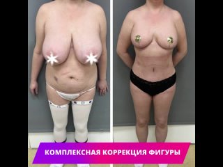 video выполнена комплексная коррекция фигуры подтяжка и уменьшение груди липоабдоминопластика sex