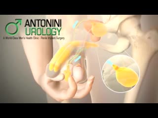 video о функциях имплантанта пениса sex