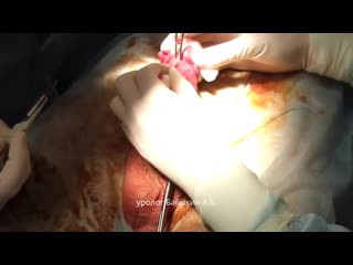 video обрезание у мужчин польза и вред процедуры циркумцизии sex