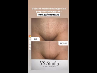 video результат лазерная эпиляция sex