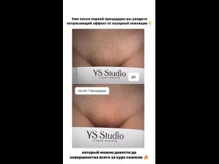 video результат лазерная эпиляция sex