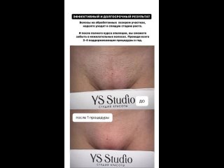 video результат лазерная эпиляция sex