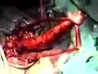 video хирургия операция по смене пола sex