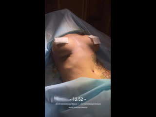 video абдоминопластика аугментационная маммопластика sex