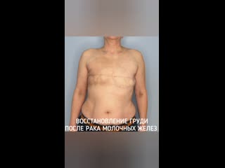 video восстановление груди после рака молочных желез sex
